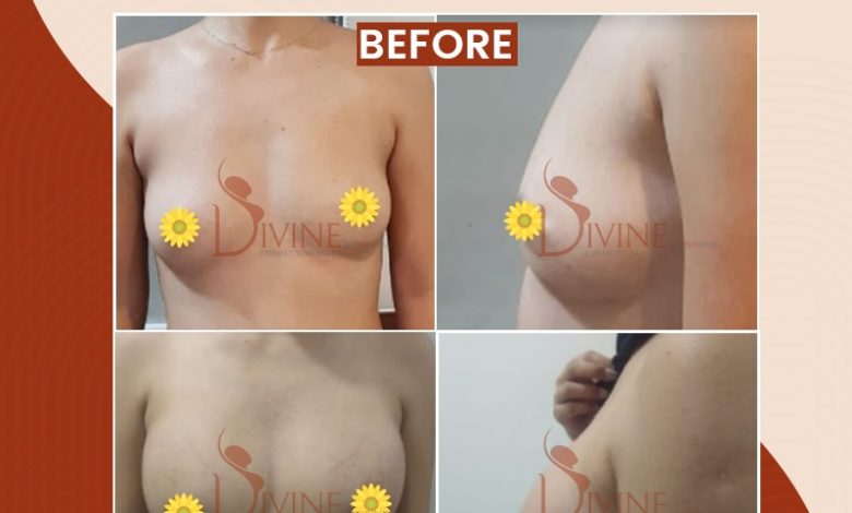 breast reduction