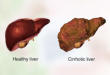 Cirrhosis-of-Liver