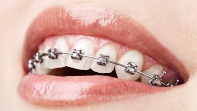 Photo of What You Can Get From the Best Teeth Alignment Treatment?