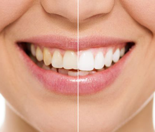 Composite Bonding