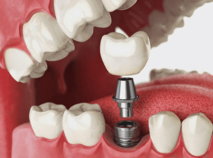 dental-implant-teeth