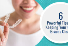 6 Powerful Tips For Keeping Your Clear Braces Clean - Chatfield Dental Braces