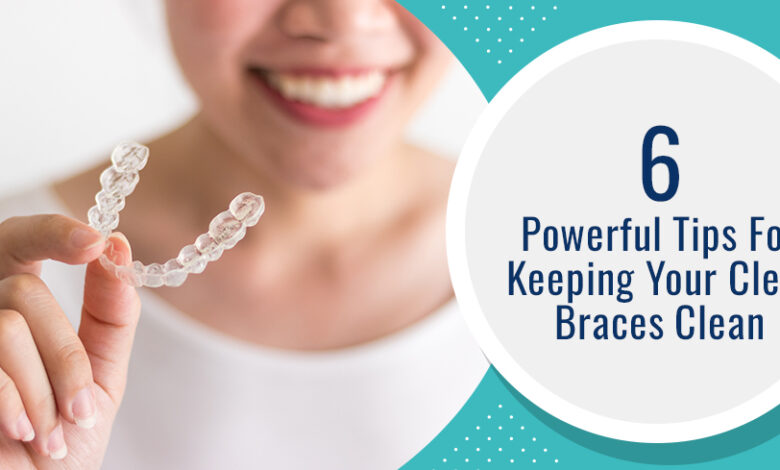 6 Powerful Tips For Keeping Your Clear Braces Clean - Chatfield Dental Braces