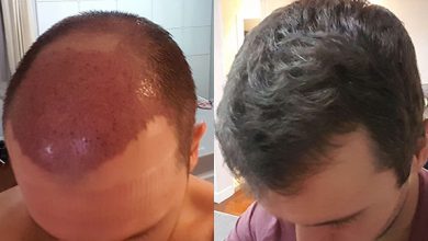 Photo of An overview of Hair transplant cost in Dubai