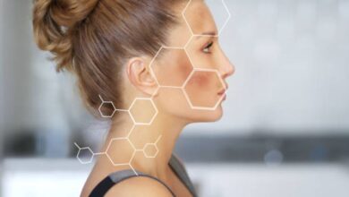 Lees Summit Hyperpigmentation