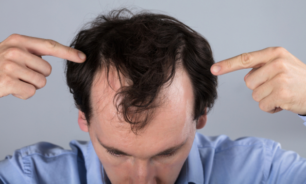 Hair Transplant procedure