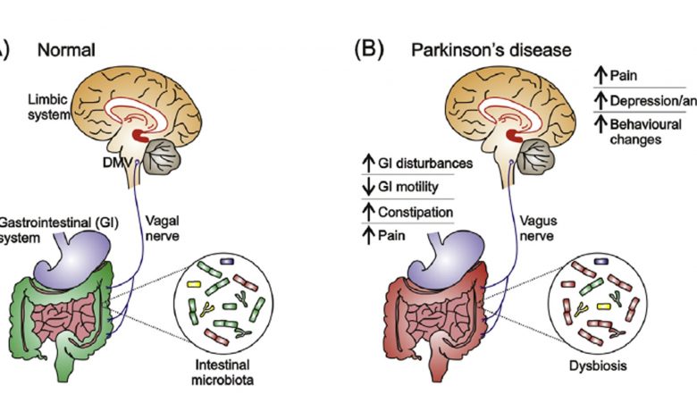 parkinson