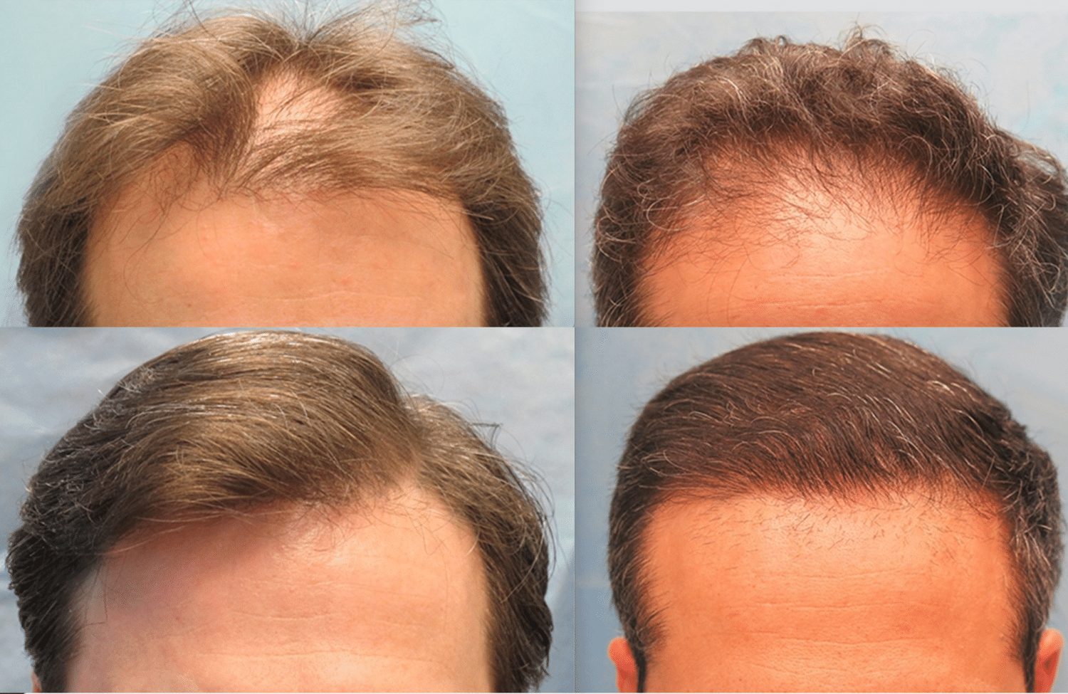 FUE Hair Transplant-Hair Transplant