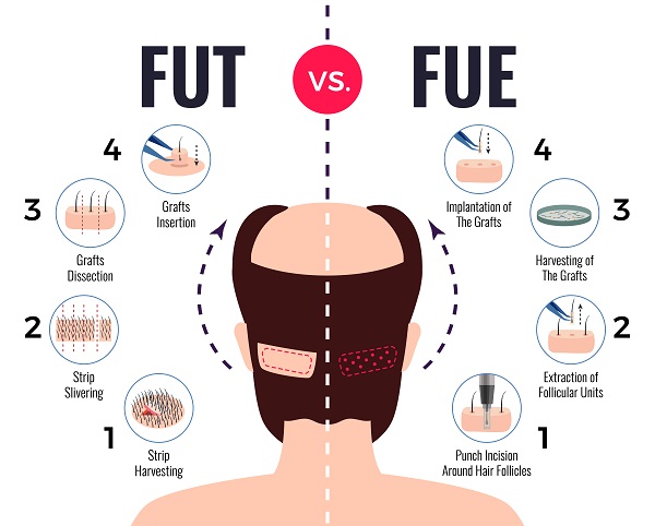 FUT vs FUE Hair Transplant