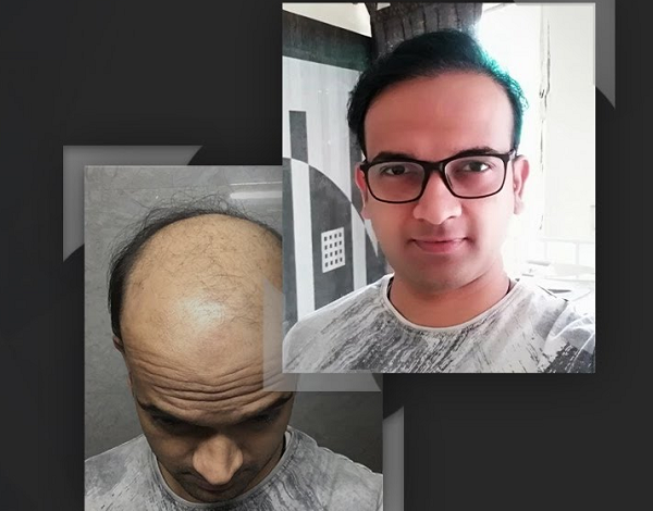 Hair Transplant Result