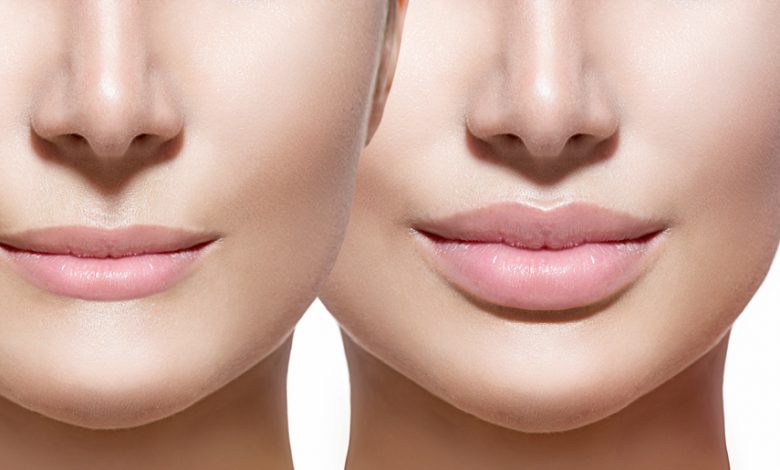 Lip Fillers