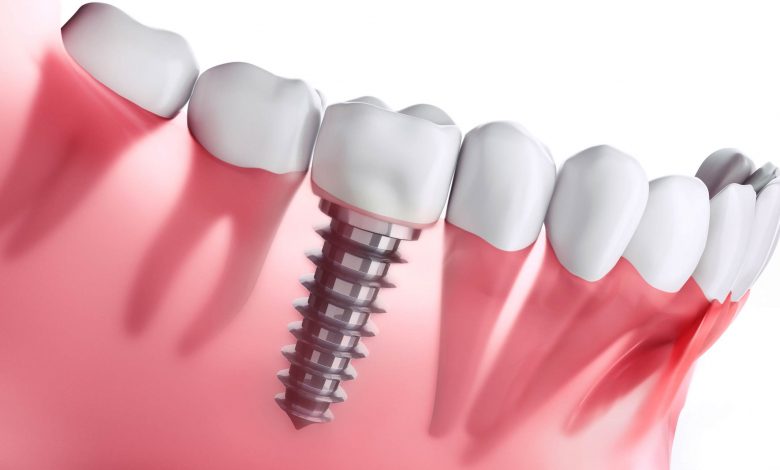 Cost of Denture Implants Brisbane