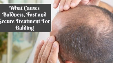 causes of bald spots- What Causes Baldness, Fast and Secure Treatment For Balding