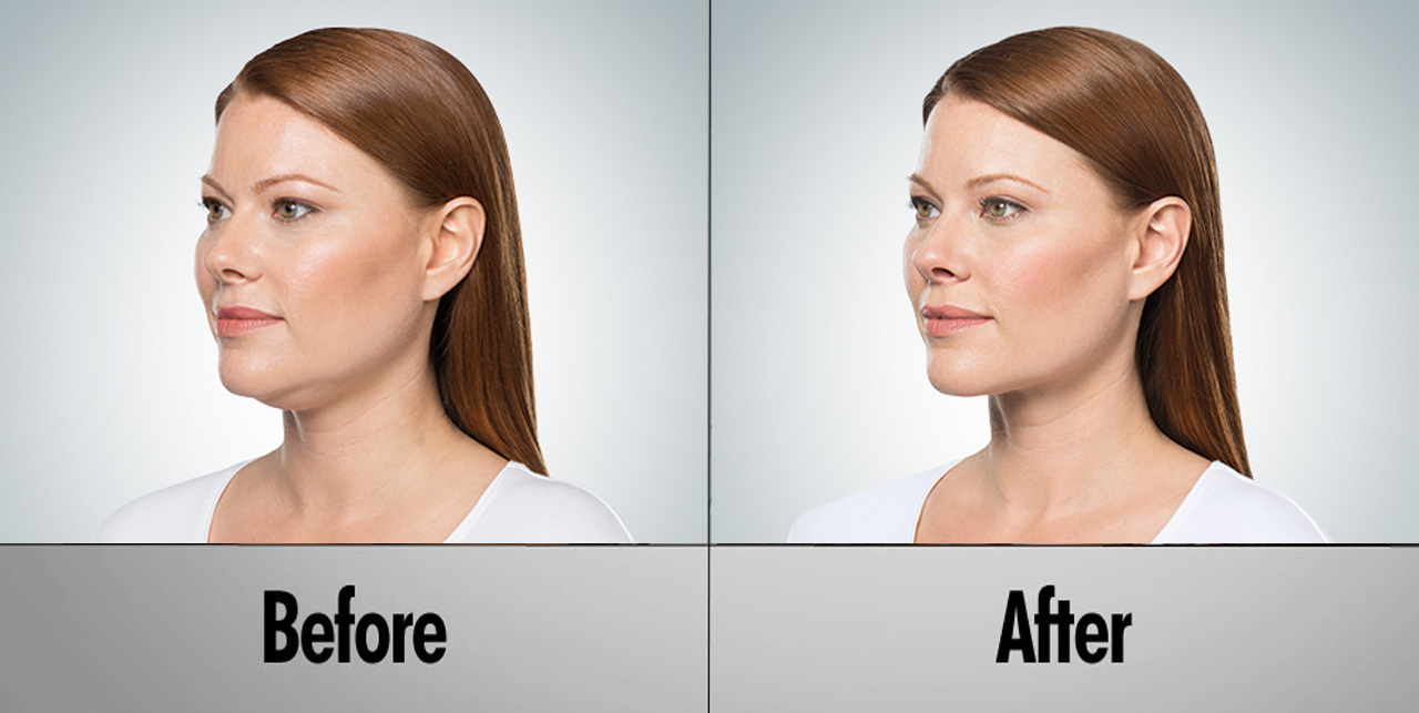 coolsculpting vs kybella
