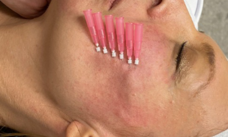 PDO thread lift real patient