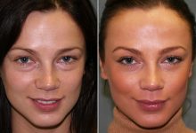 prp facial