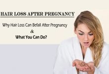 hair loss after pregnancy- Why Hair Loss Can Befall After Pregnancy and What You Can Do?