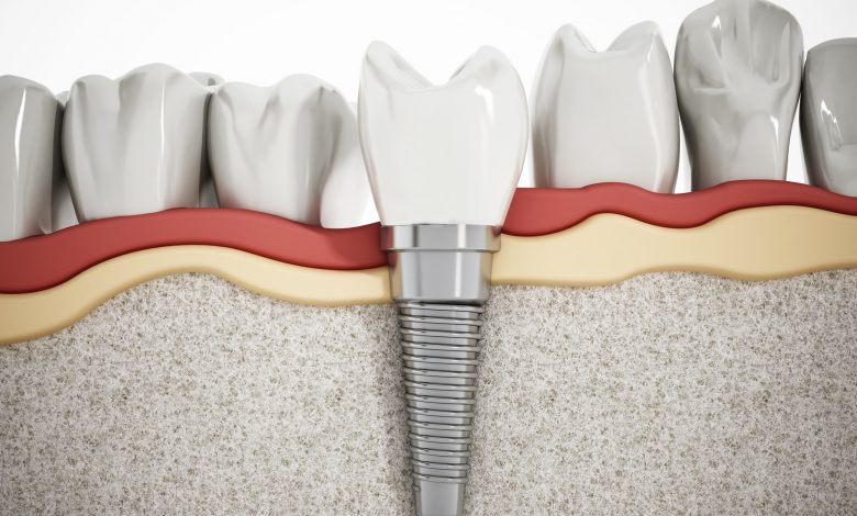 types of dental implants