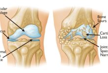 Knee dislocations