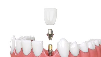 Photo of What Are Some Types of Dental Implants?