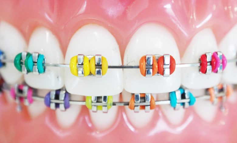 braces band colors