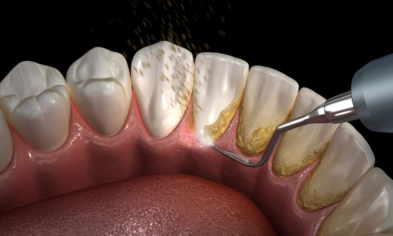teeth cleaning near me