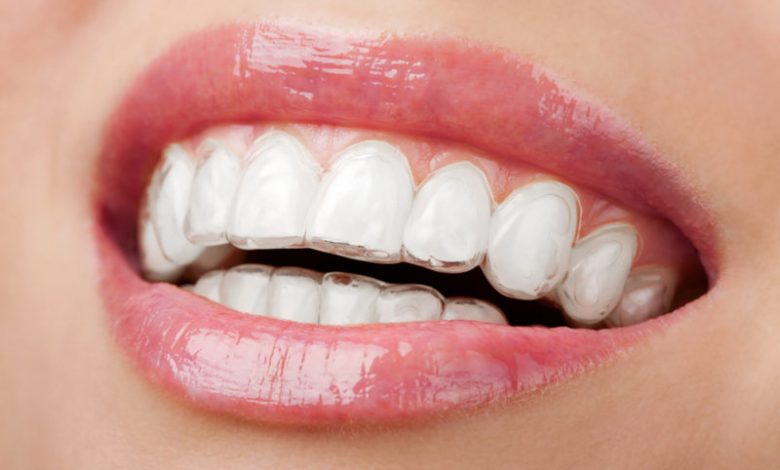 invisalign london