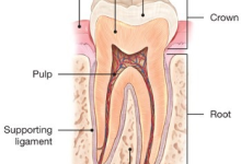 Root Canal Cracked Tooth