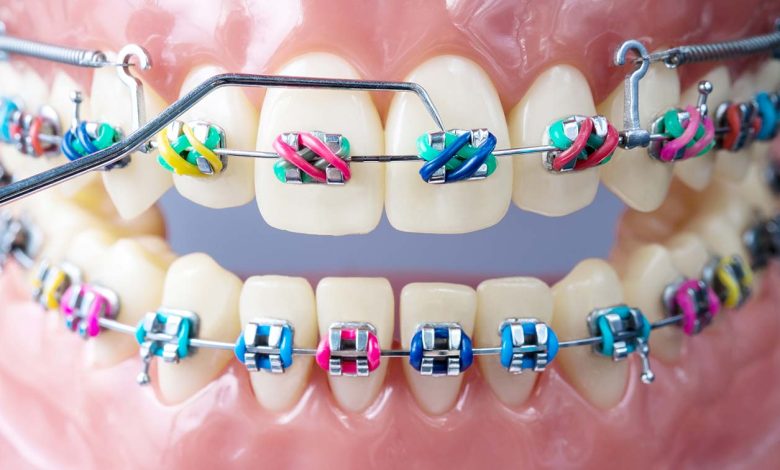 braces color wheel