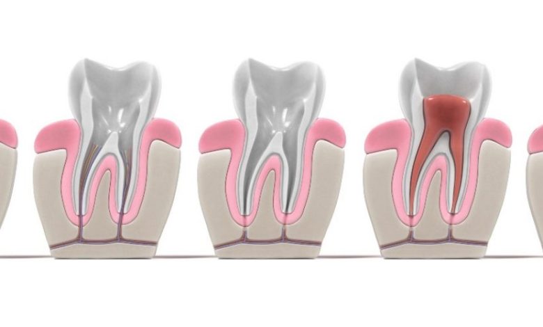 emergency root canal
