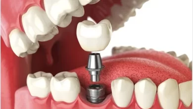 Photo of An Overview of Dental Implants