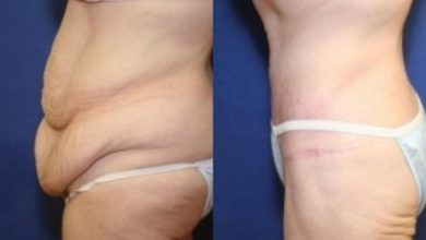 Photo of What Is Tummy Tuck (Abdominoplasty)?