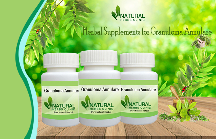Herbal Supplements for Granuloma Annulare