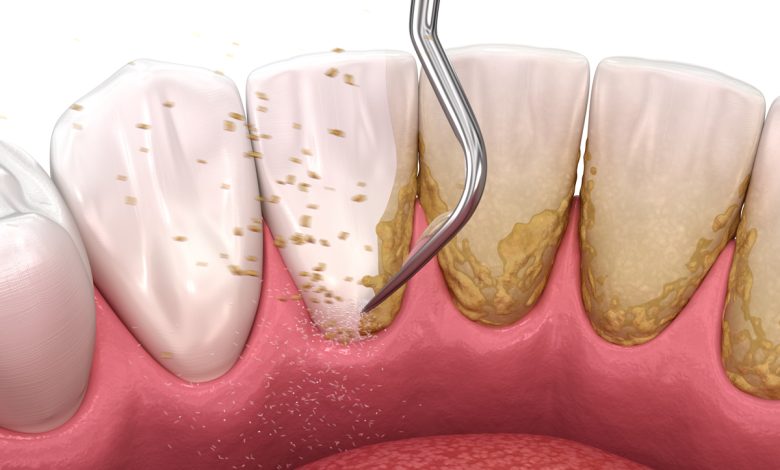 deep cleaning dental cost