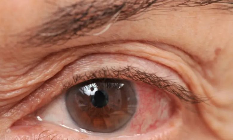 dry eye featured image