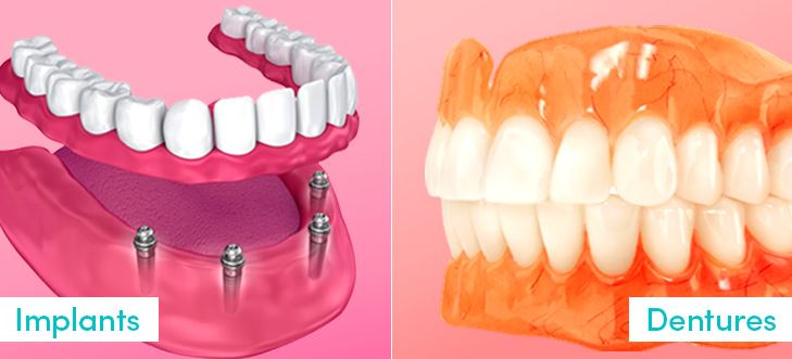 dentures and implants