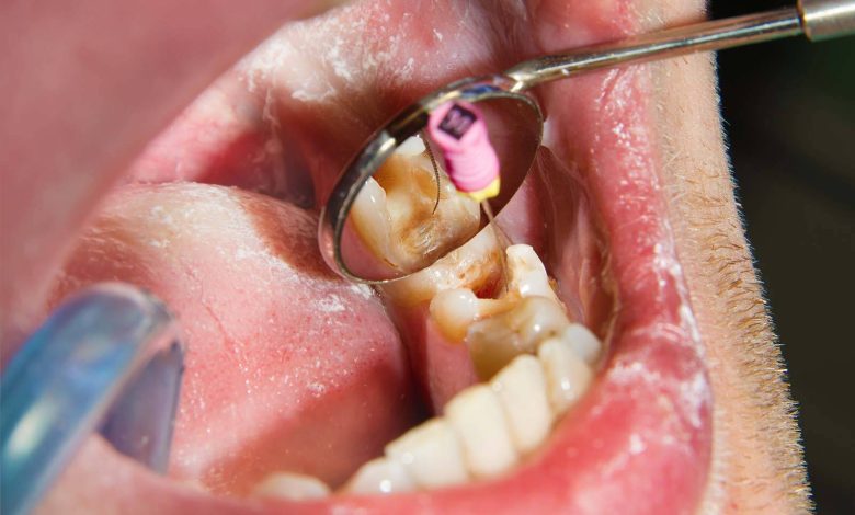 root canal near me
