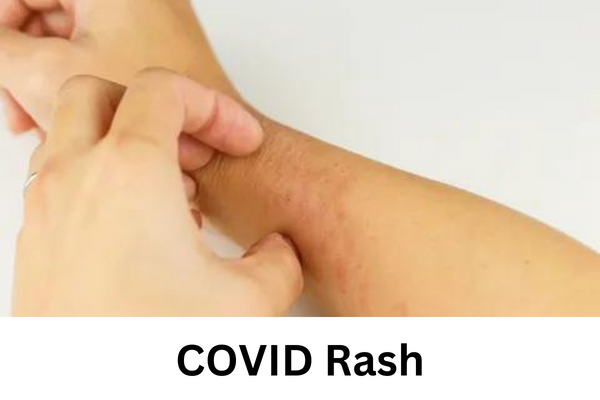 COVID Rash