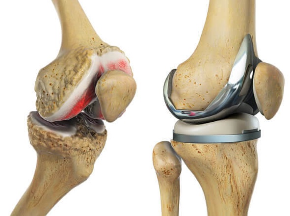 joint replacement recovery