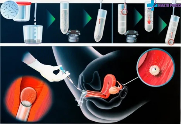 ICD 10 Code for Intrauterine Pregnancy